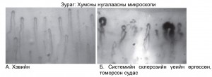 Raynaud-8