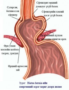 reflux2