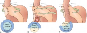 reflux6_fundoplication