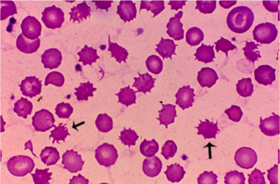 acanthoscytes