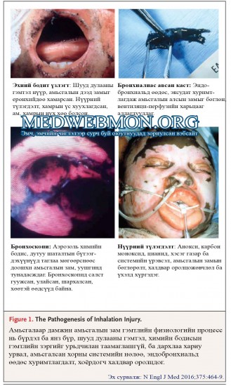 inhalation-injury-2